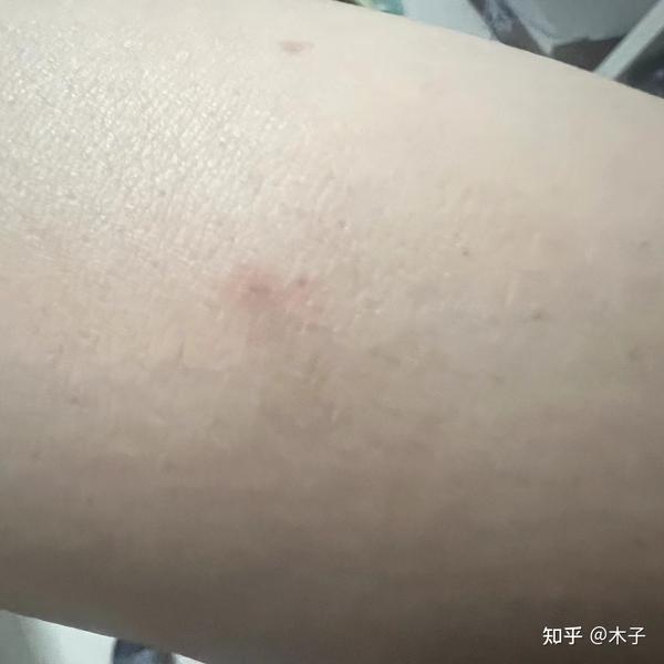 一次浑身瘙痒的自我诊断 - 知乎