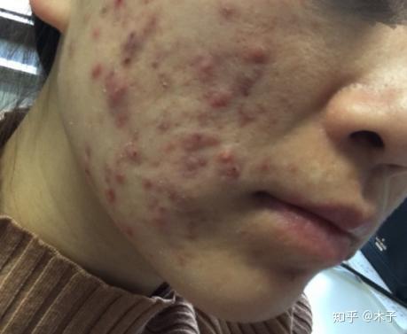 微针后反黑多久能好,如何愉快的渡过微针后反黑期?