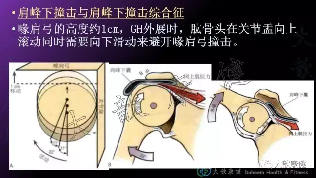 肩峰下撞击综合征运动康复