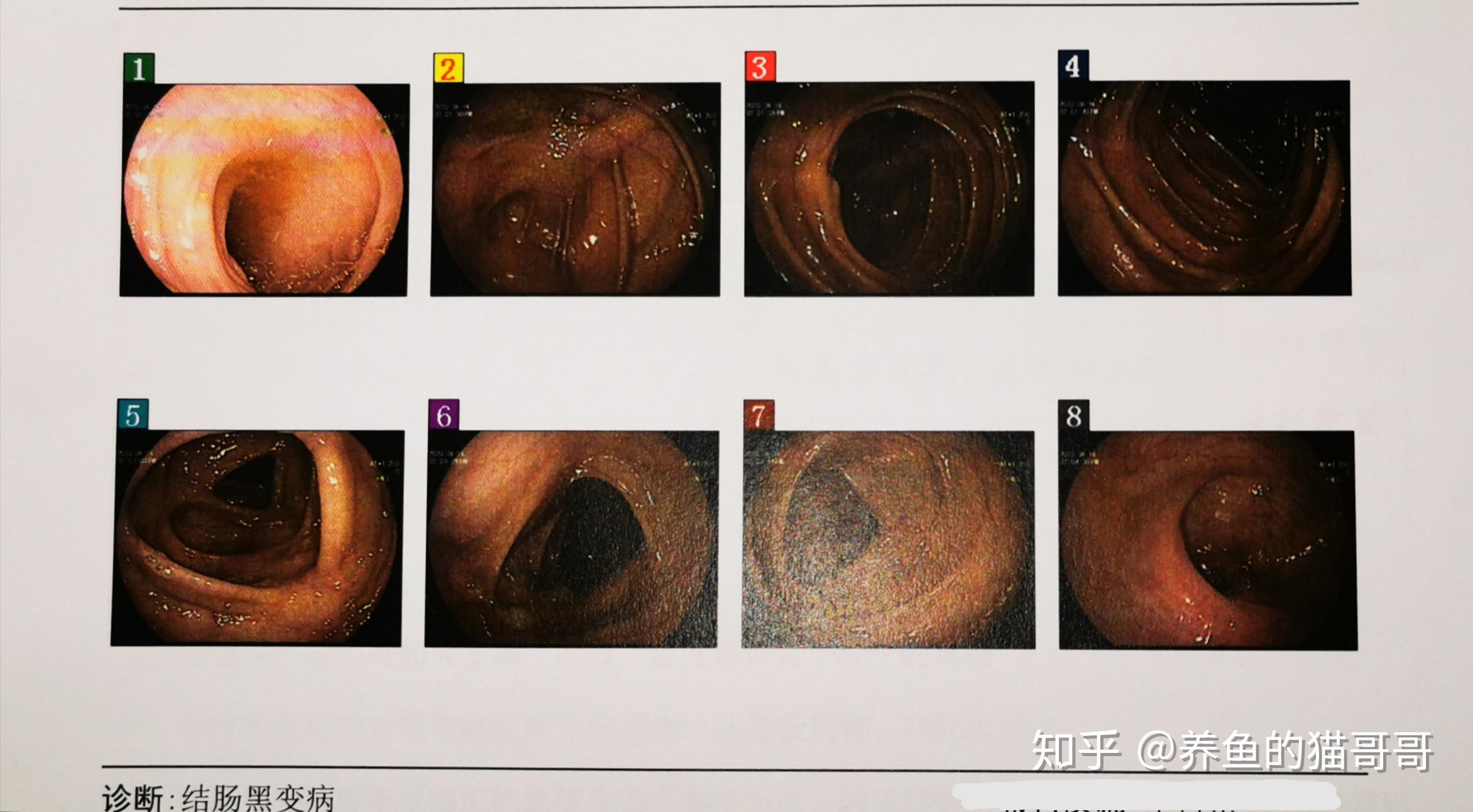 下巴起大包结肠黑变病日本小粉丸肠镜胃镜检查流程