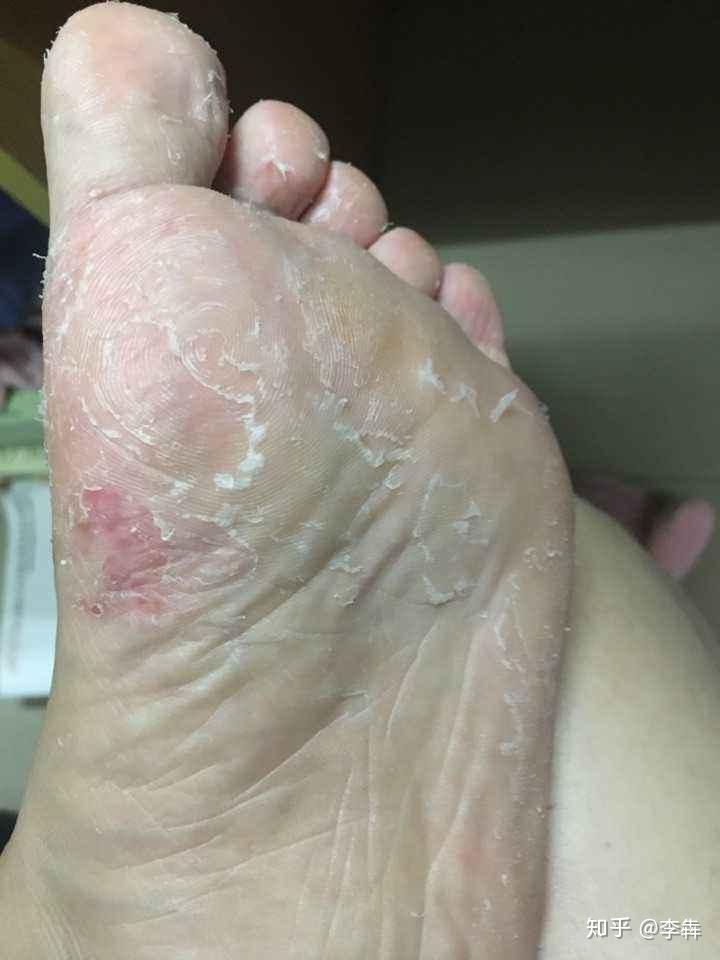 脚气的4种类型和10种级别来对号入座啦