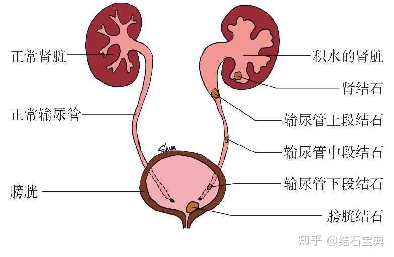 输尿管间襞图片