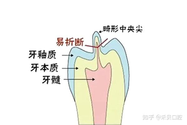 ”不定时炸弹“——畸形中央尖!! - 知乎