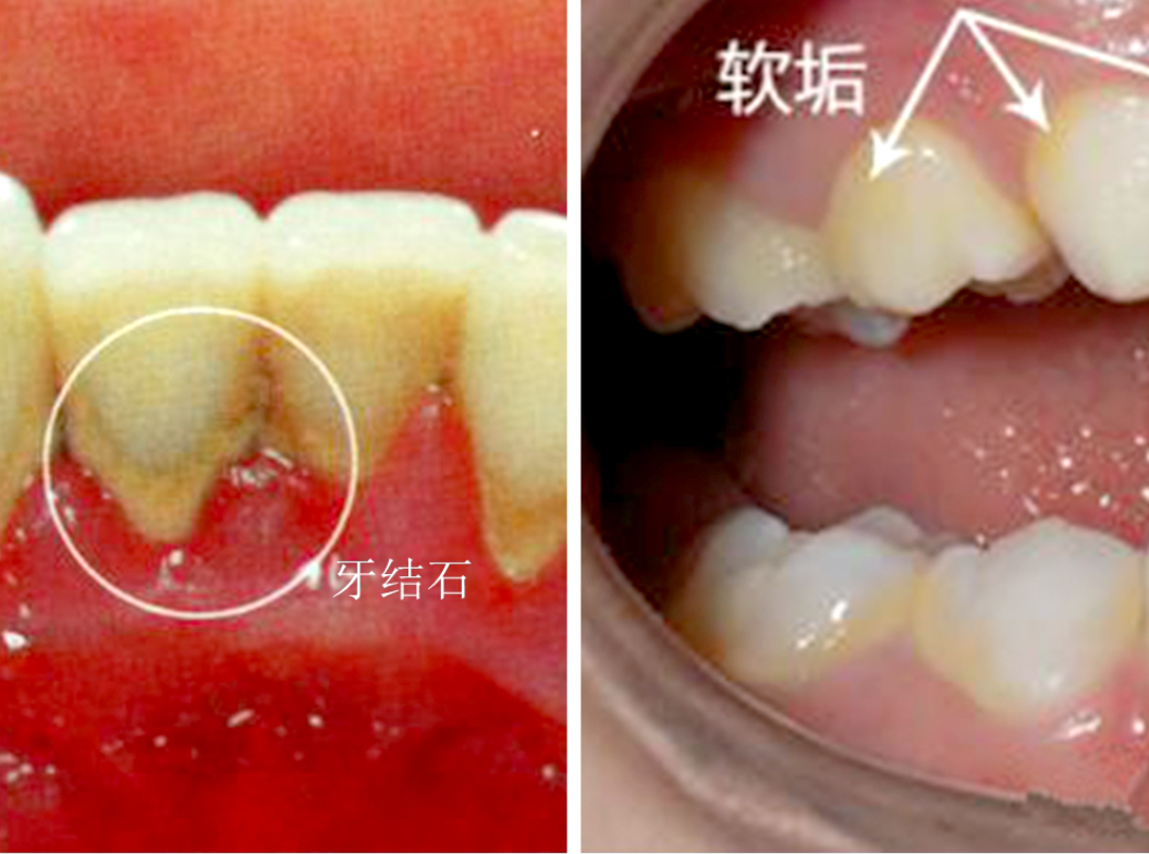 牙结石的分度图片图片