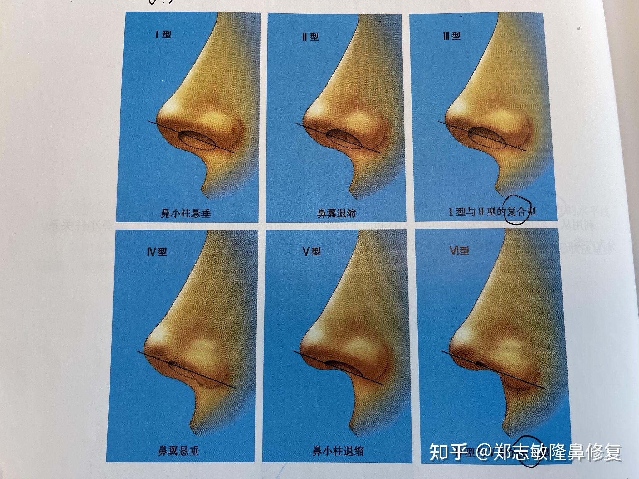 出现鼻翼缘退缩的常见原因?又该如何解决鼻翼缘退缩? - 知乎
