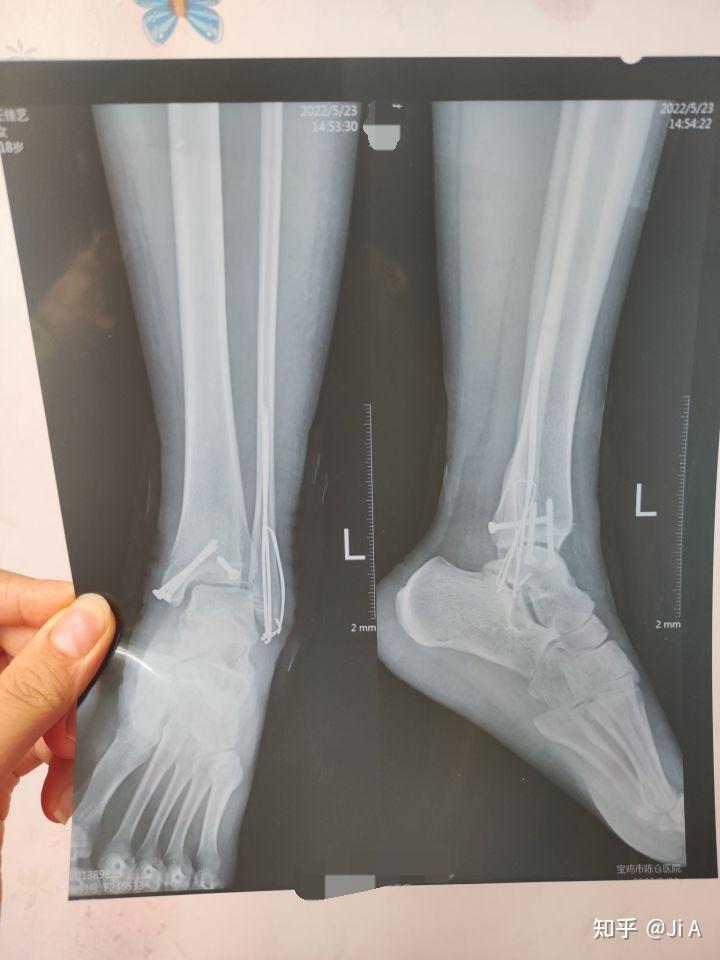 脚骨裂的x光图片图片