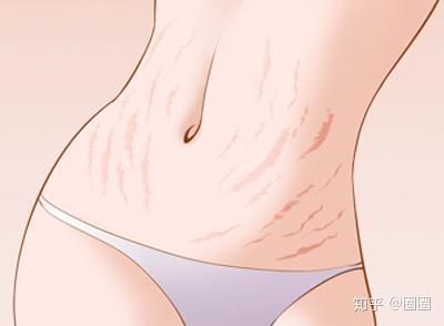 妊娠纹是什么样的