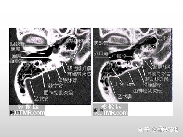 面神经解剖及相关病变 - 知乎