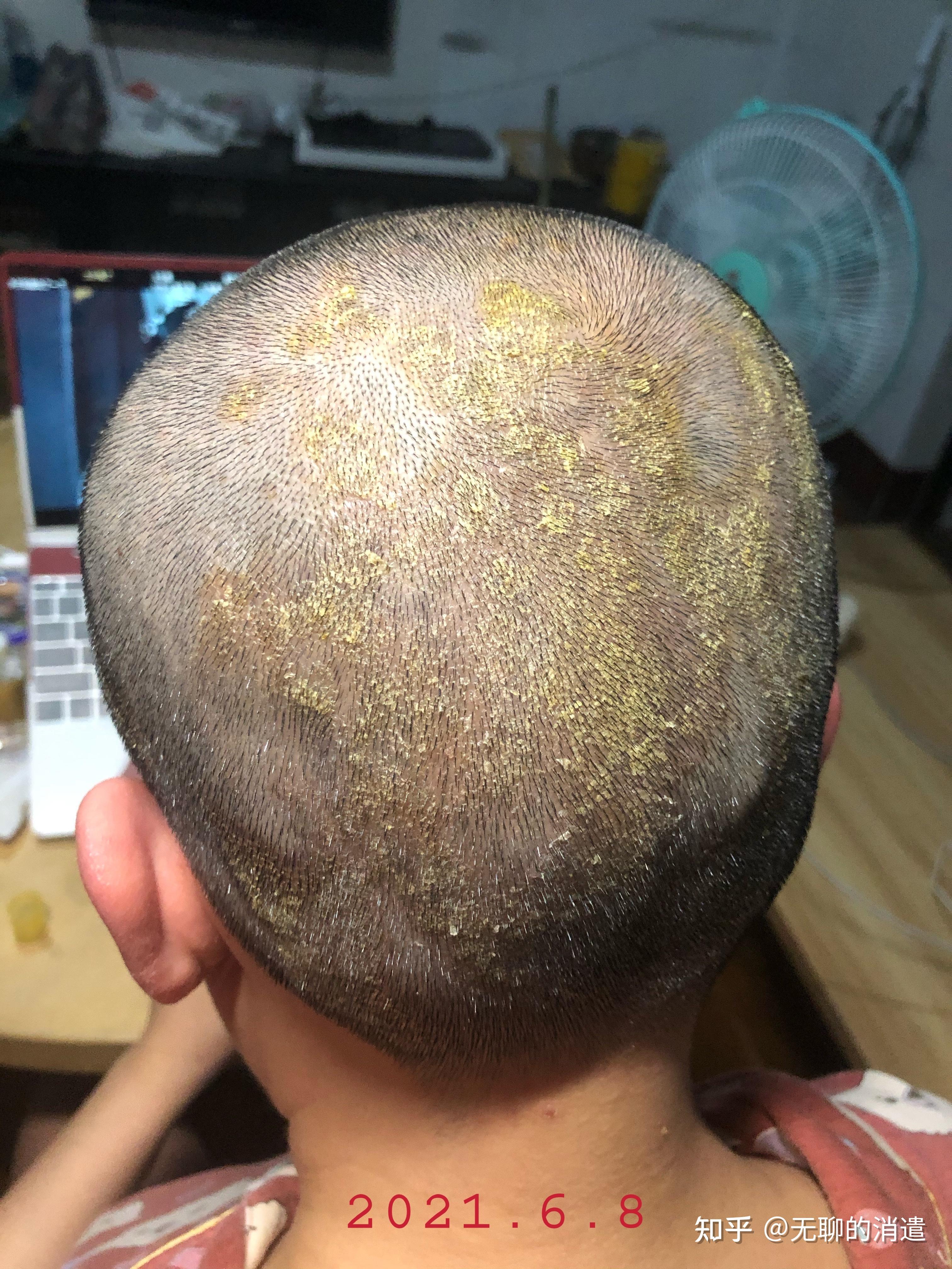 头部皮炎治疗记录贴