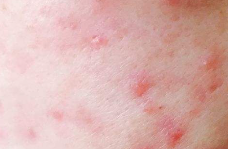 遇到春敏,过敏泛红,长痘痘,红痘印等"红色危机"该怎么办?