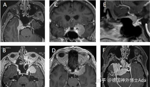 鞍旁脑膜瘤综述:分类、诊断、症状及治疗管理 - 知乎