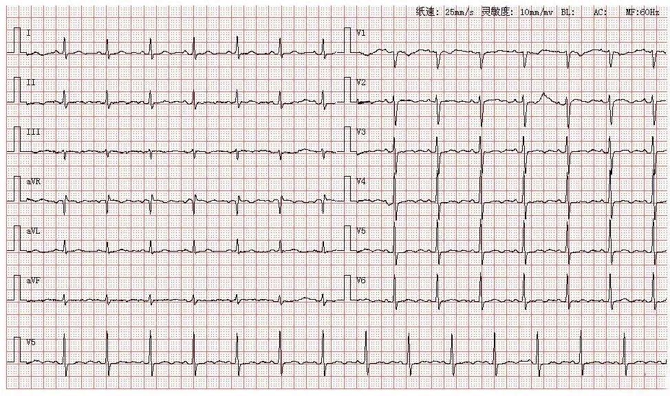 典型异常心电图图谱图片