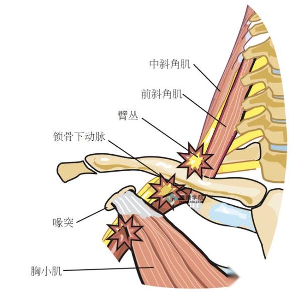 胸廓出口综合症解剖、病因、诊断和治疗 - 知乎