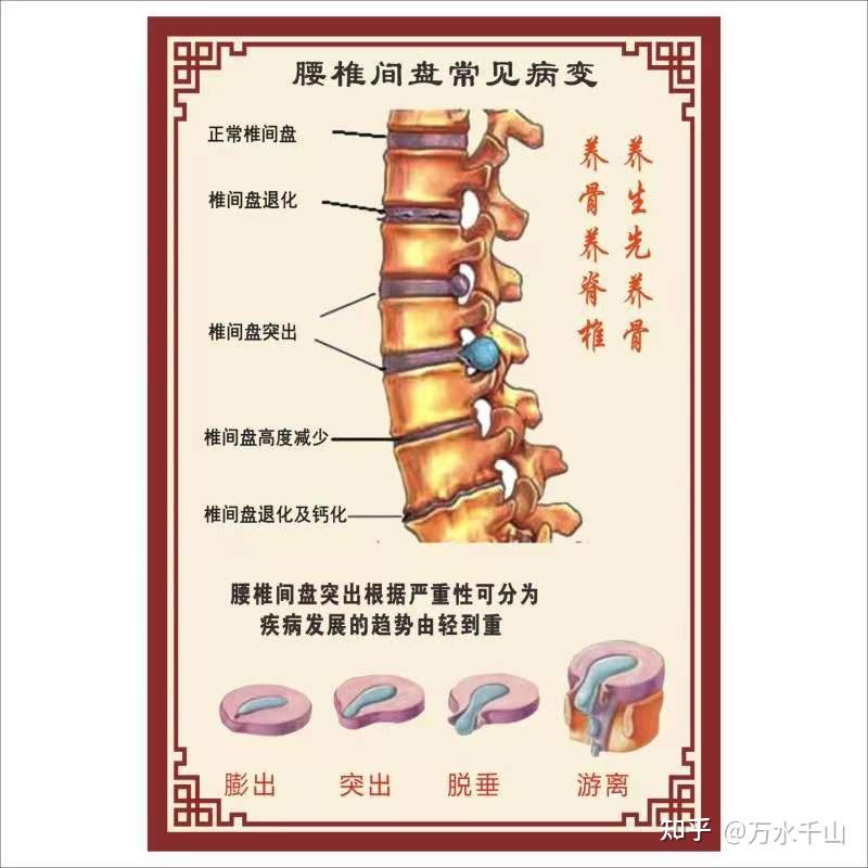 腰椎骨质增生的治疗和预防 - 知乎