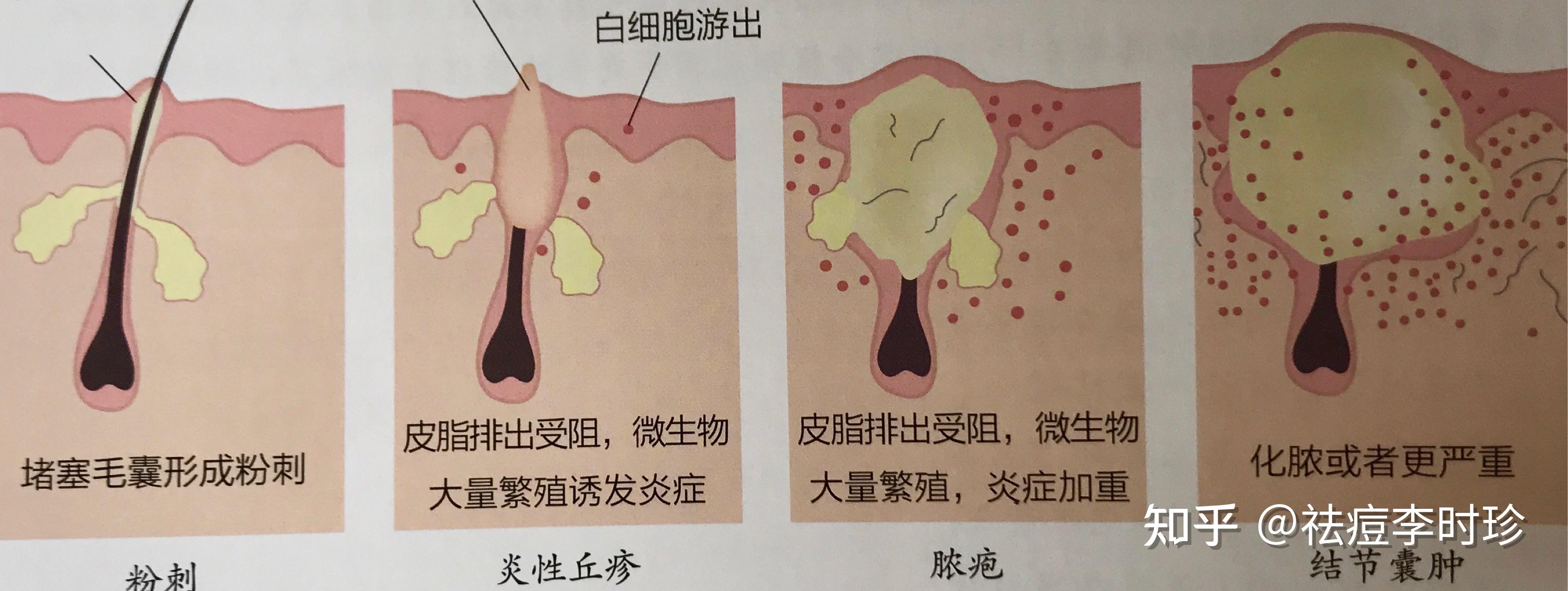 痘痘的上下五千年學會了這些臉上痘痘好一半