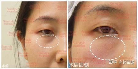 为什么有的泪沟越填反而越明显