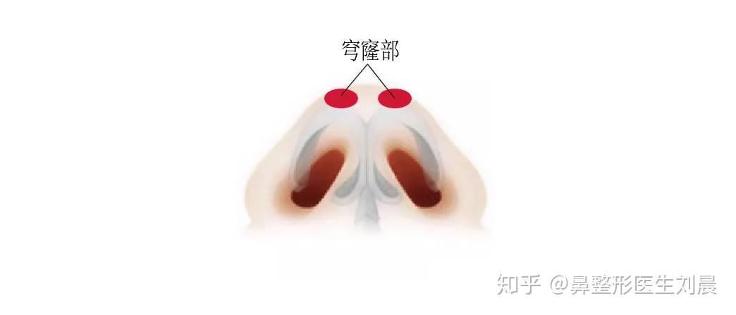 除了鼻翼软骨本身之外,在鼻翼软骨的顶端区域,被称为穹窿部,这个区域