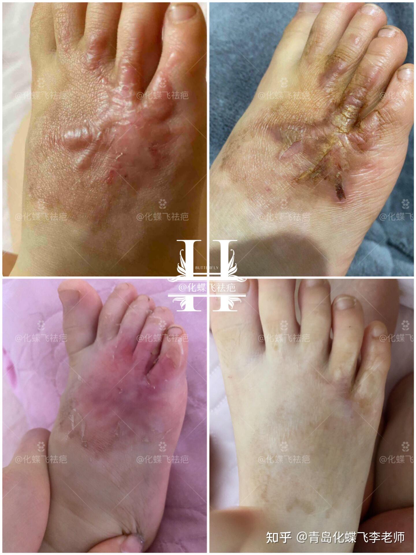 宝宝脚丫烫伤增生疤痕修复