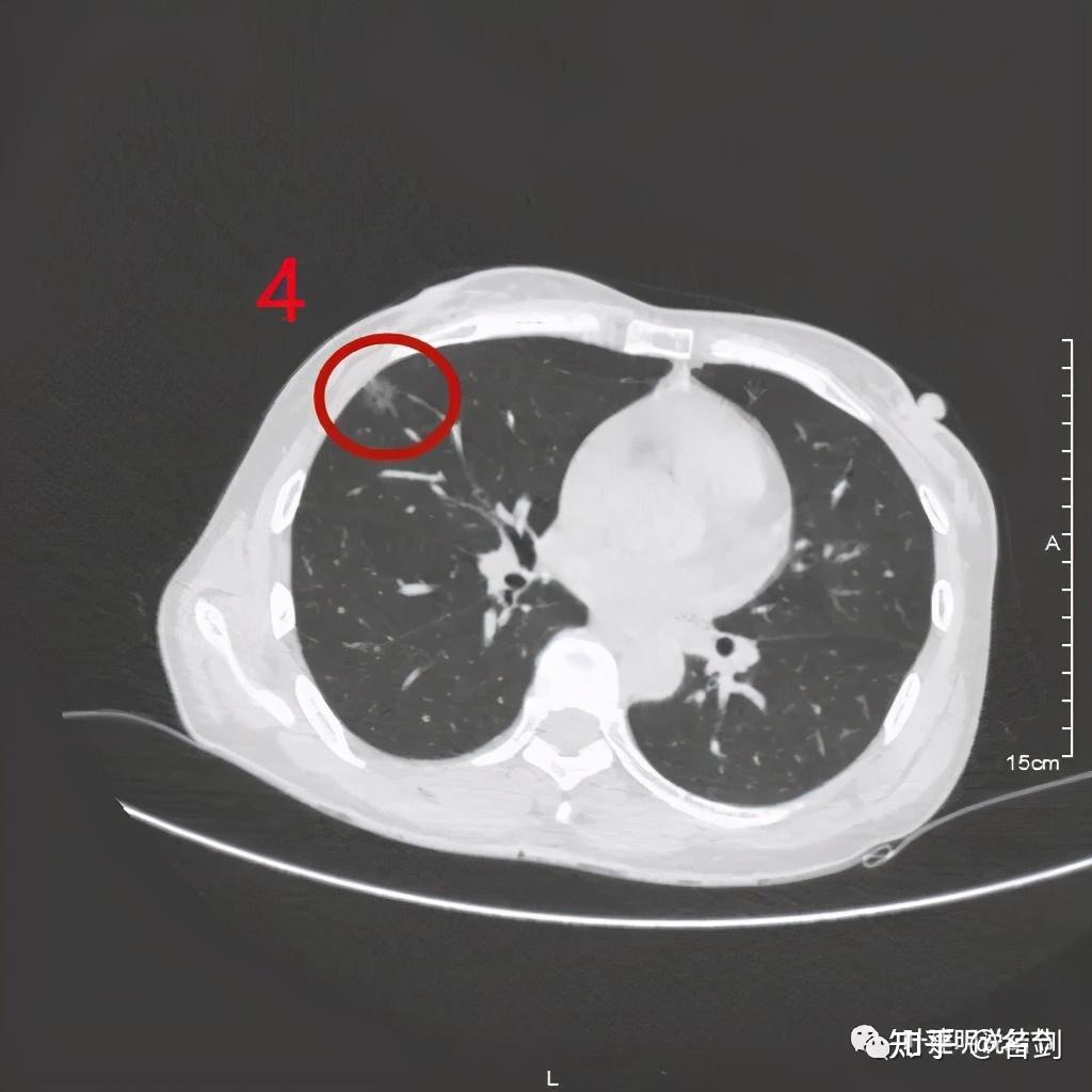 两肺多达9处结节是否要手术临床如何决策