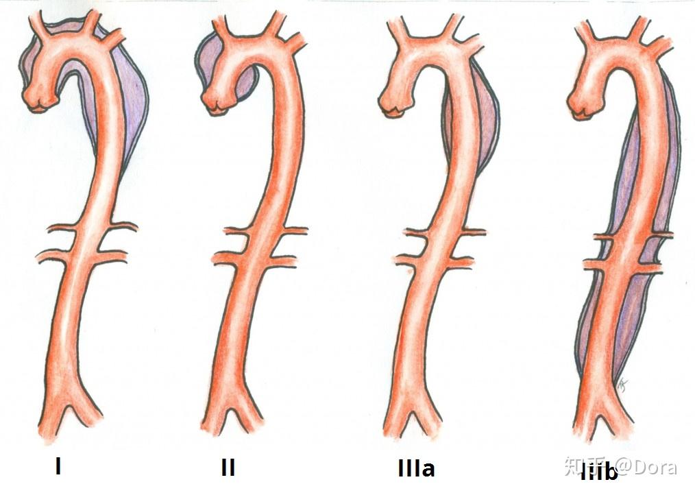 主动脉夹层b型图片