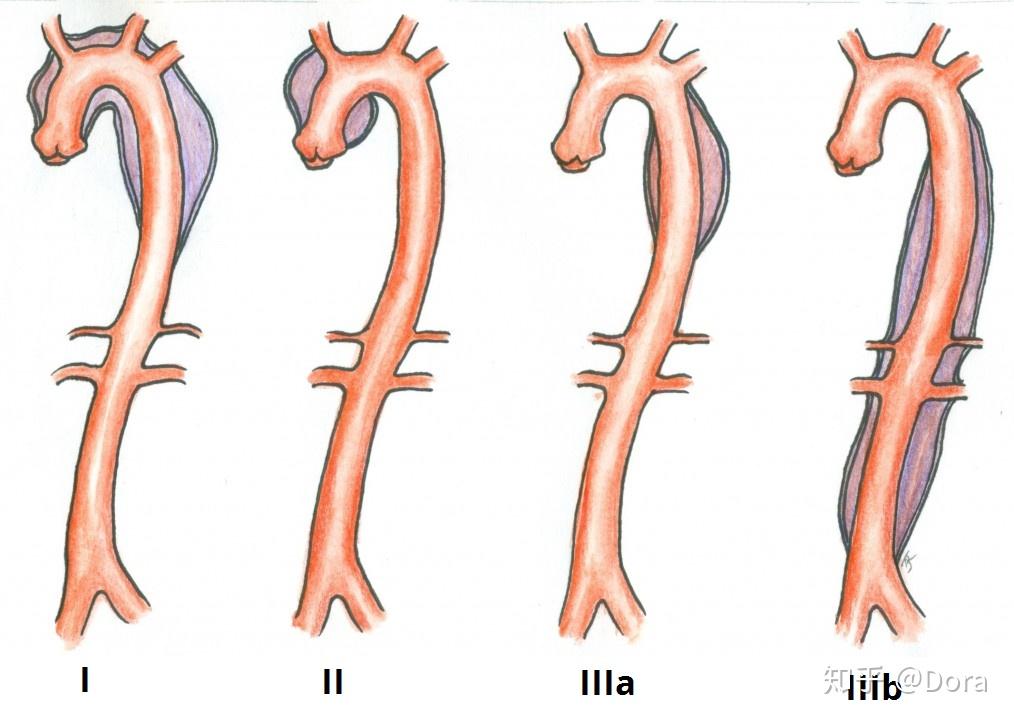 主动脉夹层stanford图片