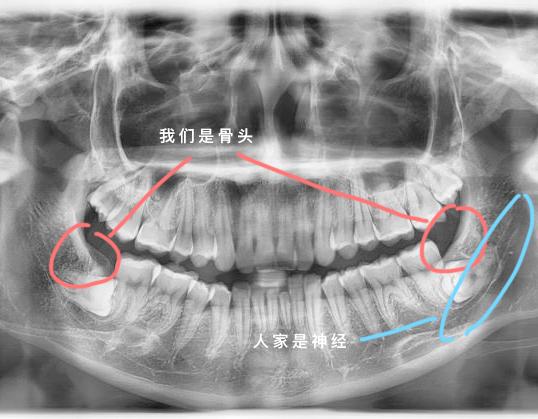 侃一侃拔除低位阻生智齿的亲身经历- 知乎