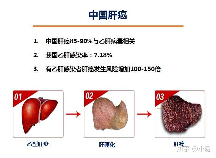 你身边有乙肝患者吗看看为何中国是肝癌大国