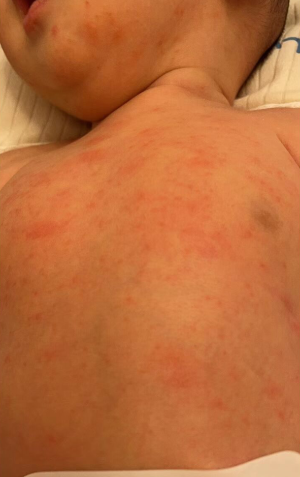 终于把宝宝身上的痱子改善了,分享一下这一路的经历和方法吧