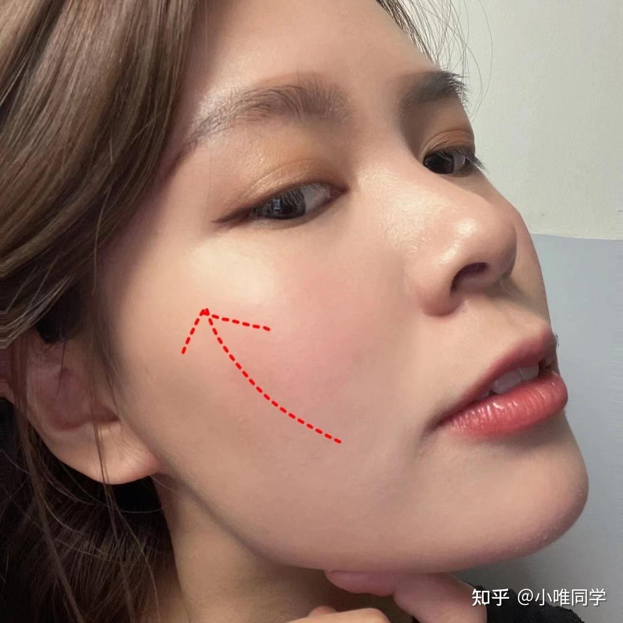 玻尿酸丰苹果肌是一个怎样的体验