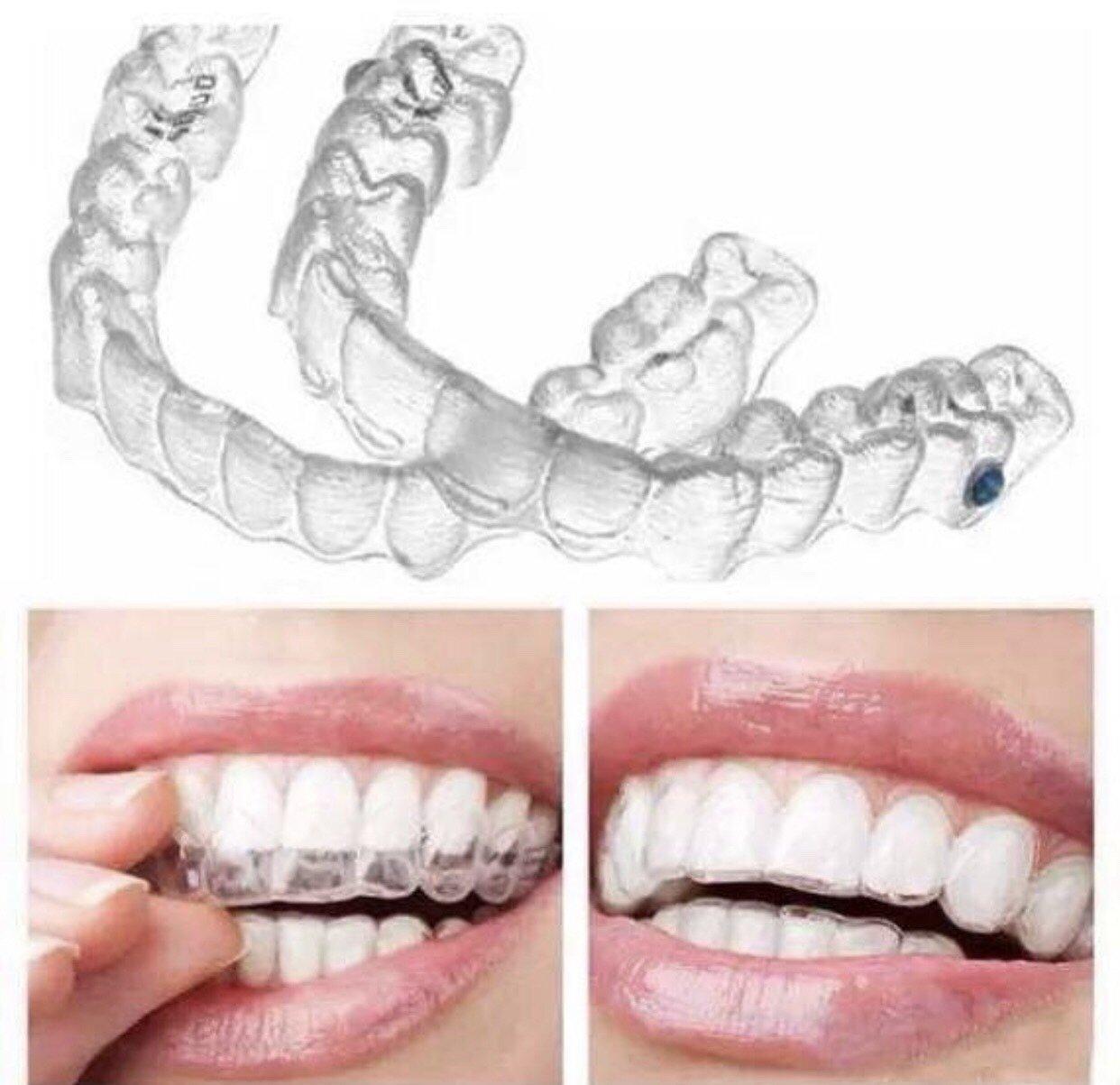 为什么医生老推荐隐适美?在上海做矫正要花多少钱?