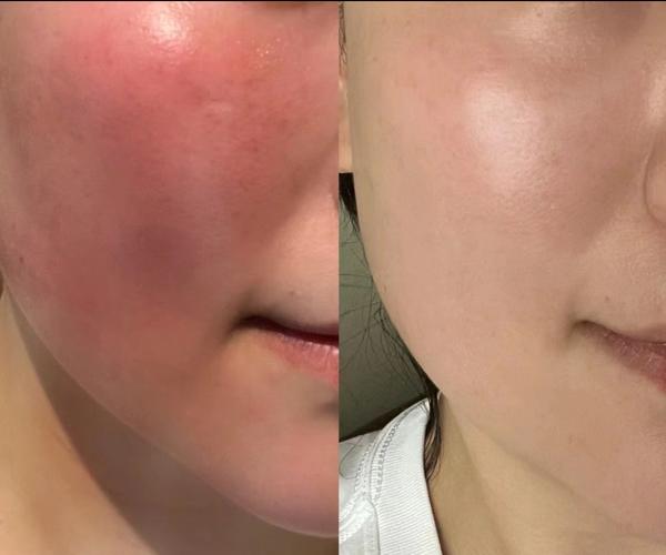 户外暴晒后怎样做晒后修复?皮肤科医生教你【专业晒后修复】步骤!拒绝晒黑、晒红、晒伤! - 知乎