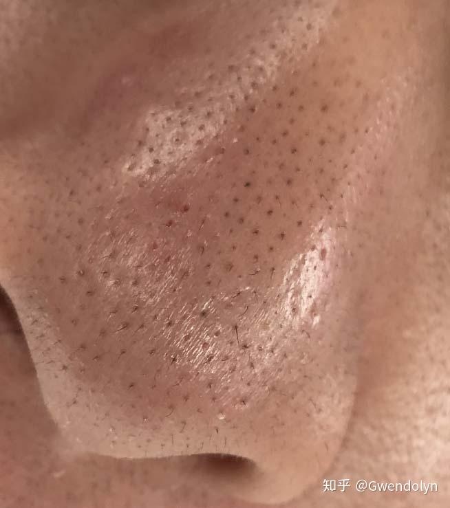 第四篇教你分辨真假黑头