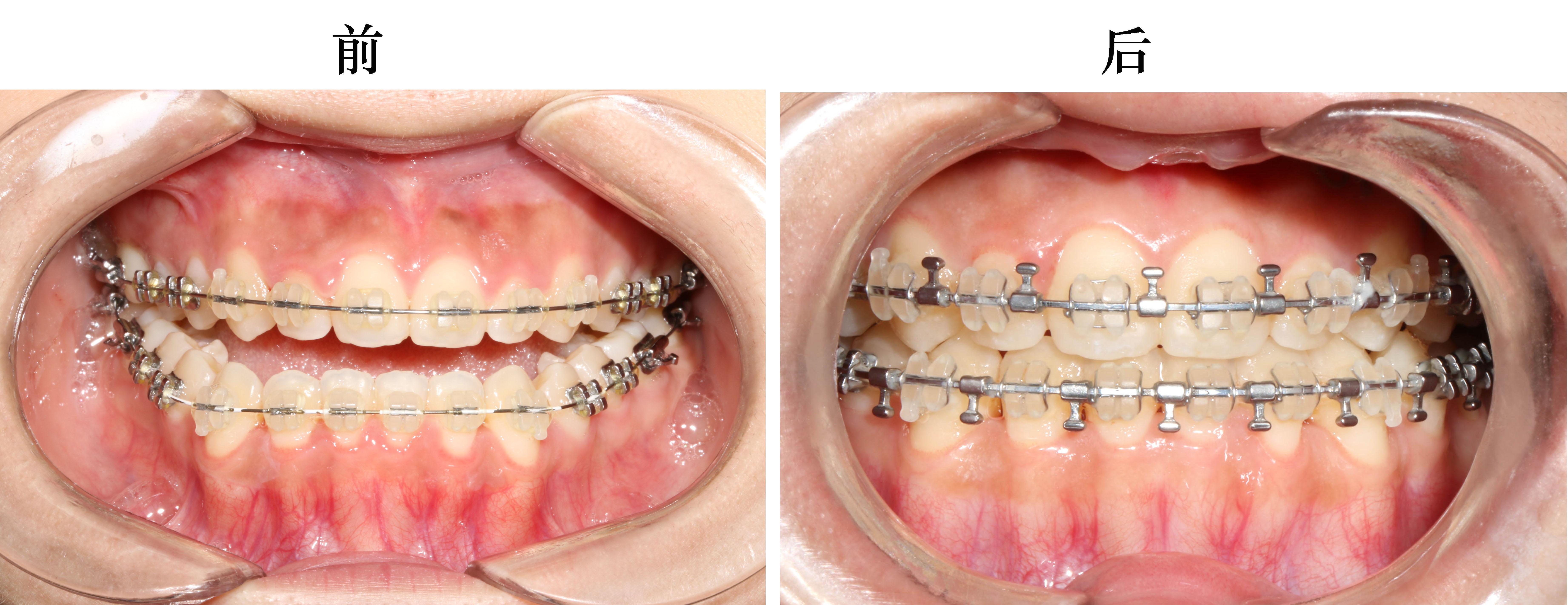 地包天手术后外貌会有怎样的变化