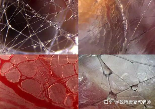 「锐博康复」筋膜到底是个啥?腰疼,腿疼,膝盖疼,竟然都和它有关!