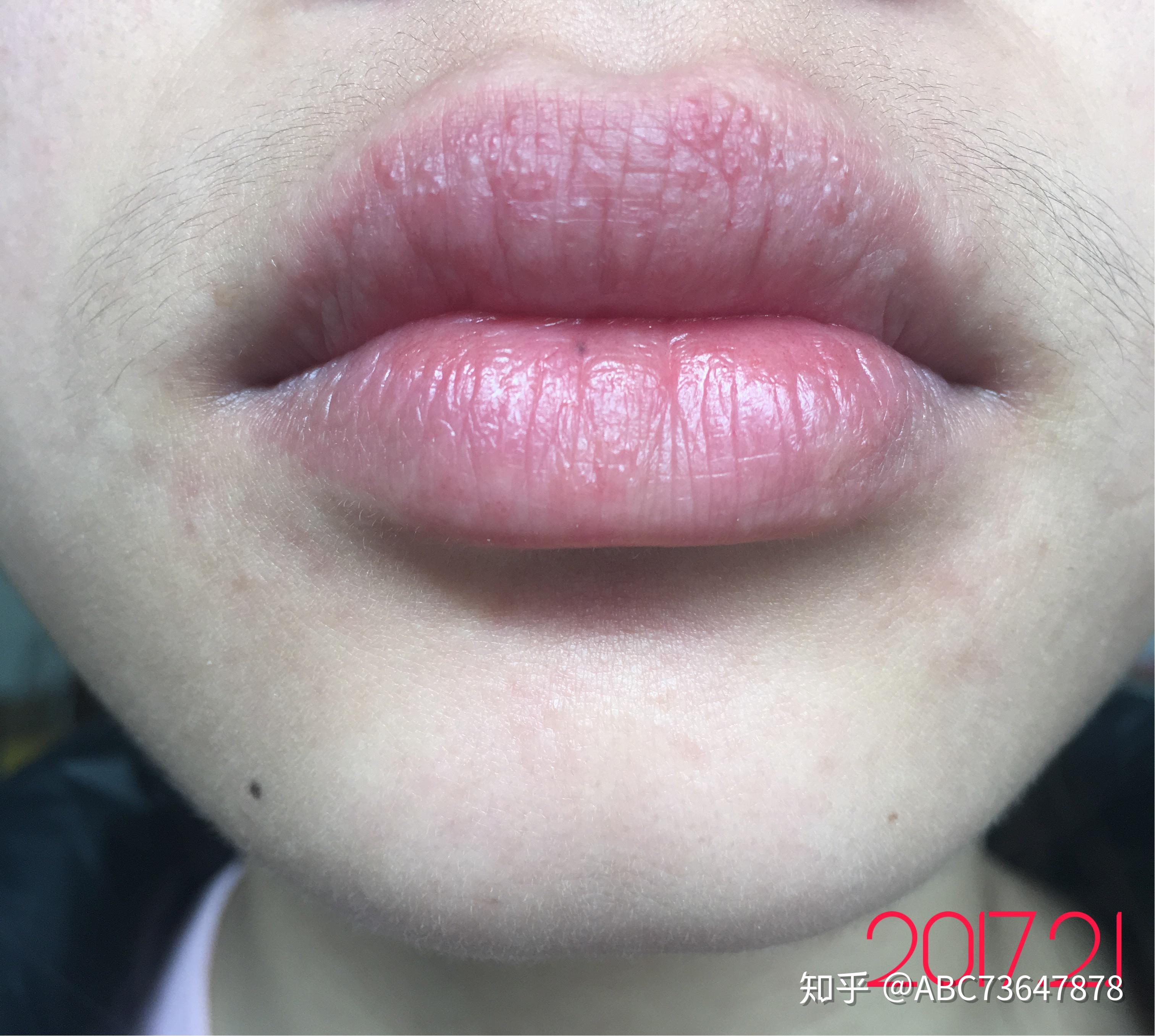 引发了全脸过敏.