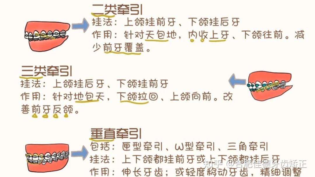 正畸三类牵引示意图图片