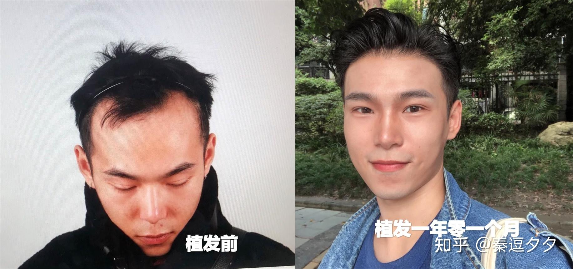 毛发种植医院手术