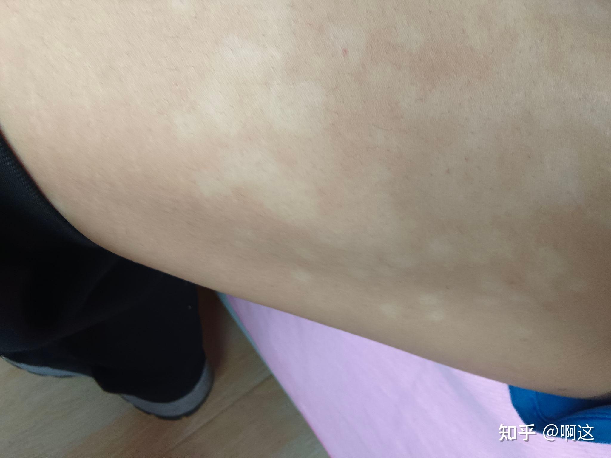 汗斑(花斑癣)炎症后色素减退斑(大面积)痊愈经验