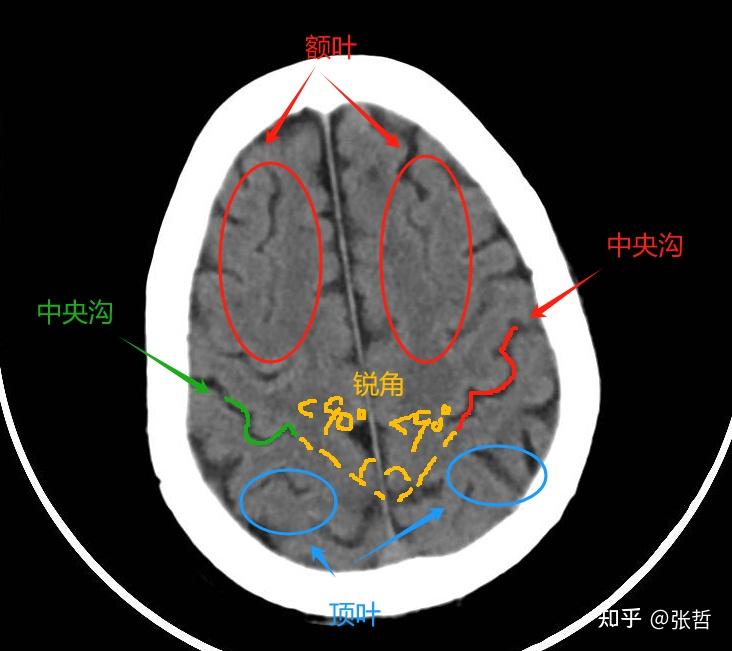 颅脑影像中如何寻找中央沟? - 知乎