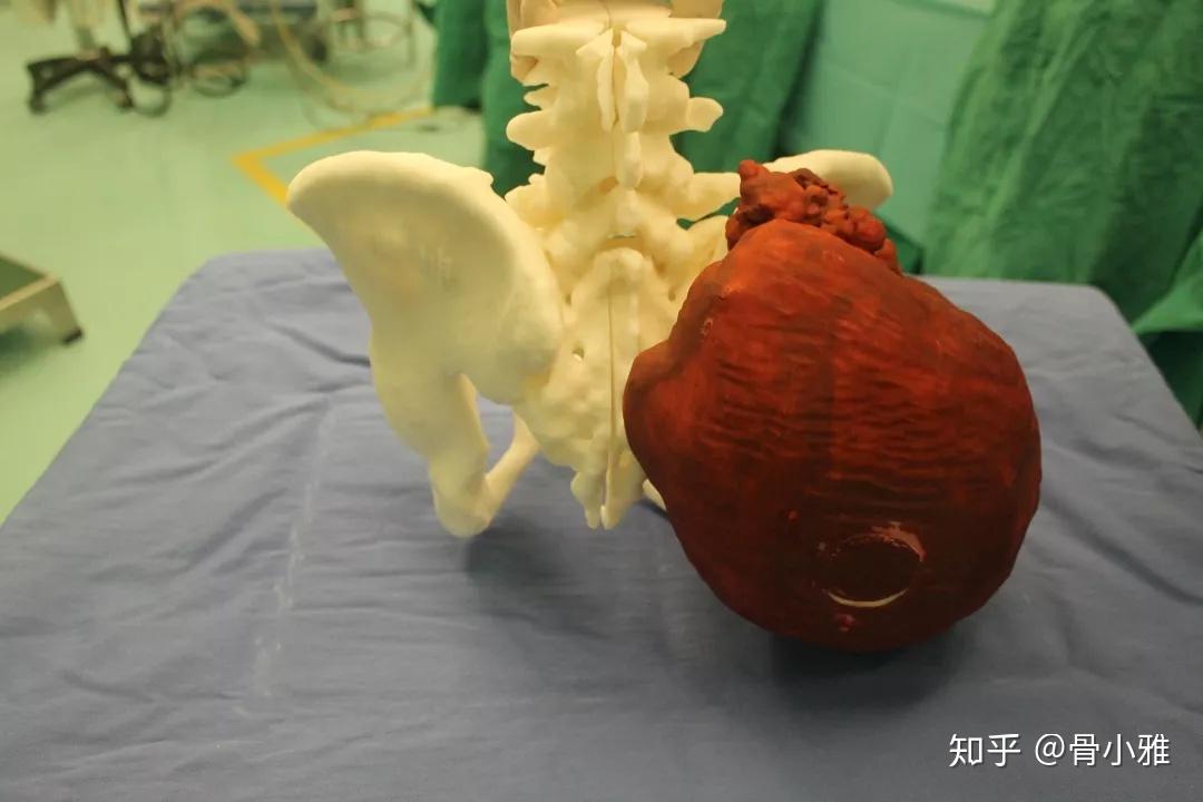 软骨肉瘤最有效的治疗是手术广泛切除.