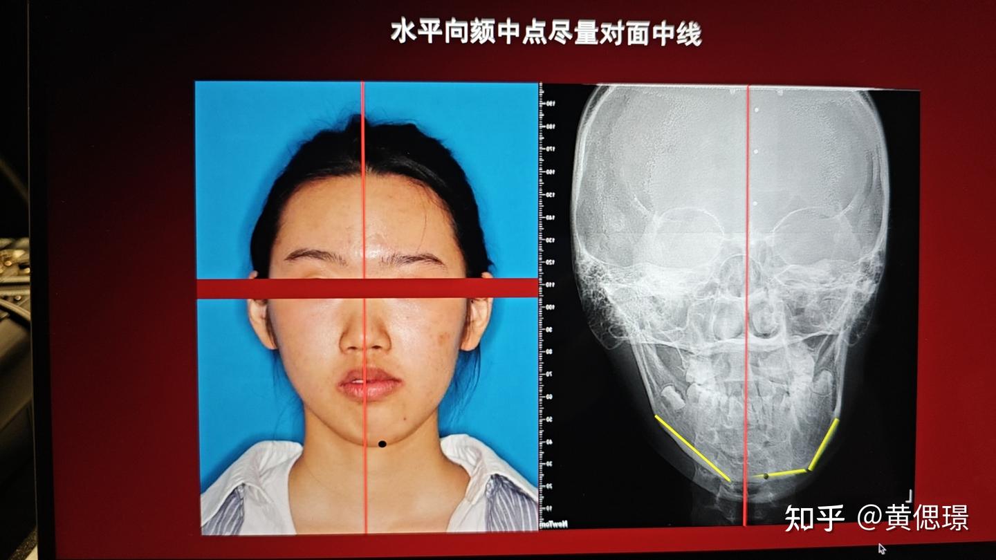 正畸诊断沈刚分类之偏颌 - 知乎