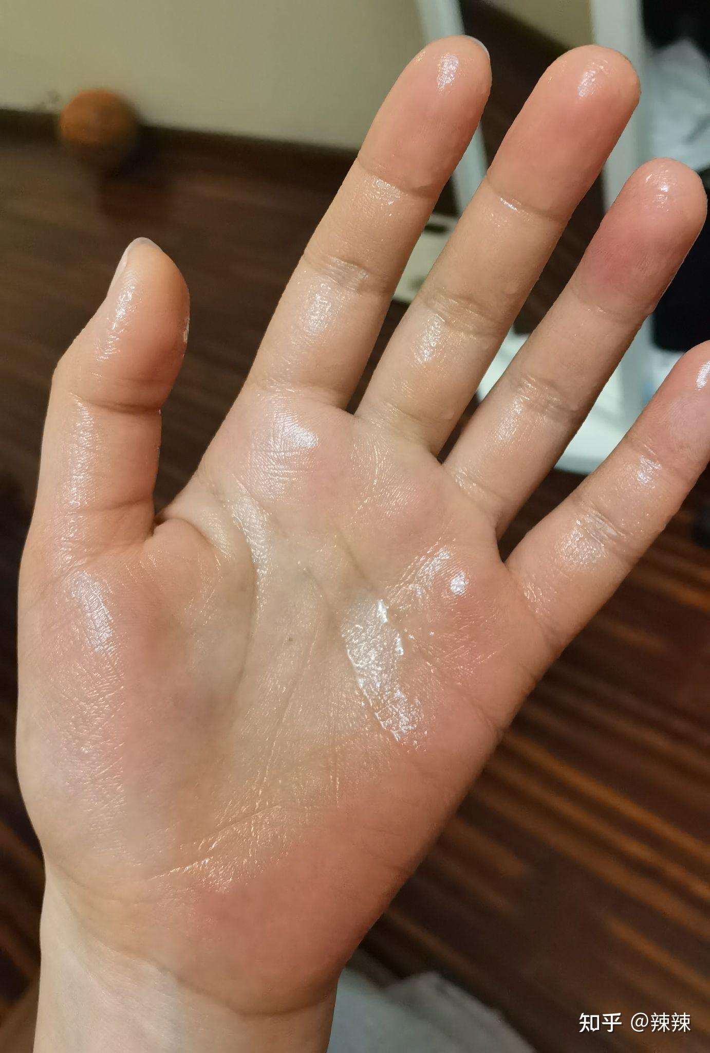 一个手汗症者的自述 - 知乎