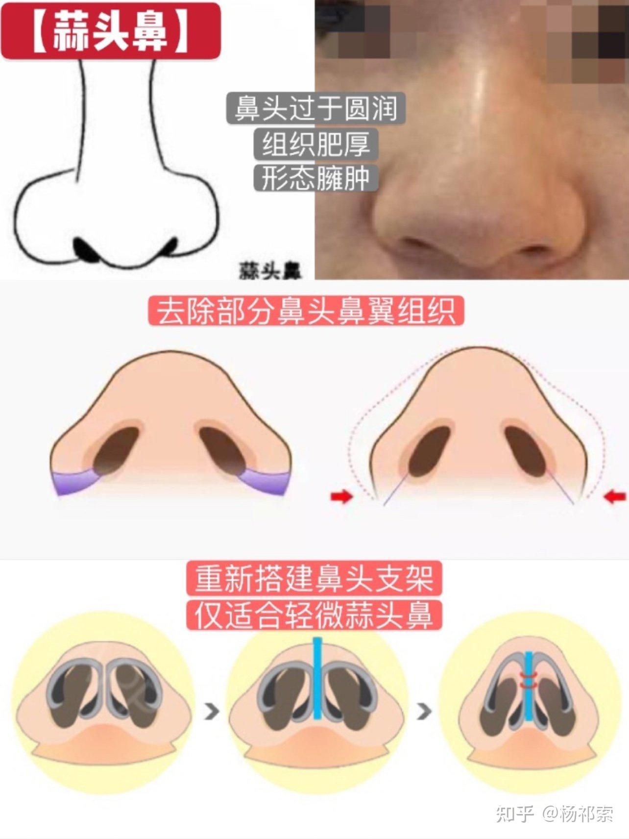 医美隆鼻整形对比海报PSD广告设计素材海报模板免费下载-享设计