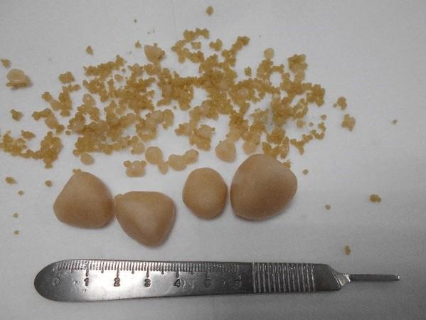 雪纳瑞小便嗷嗷叫兽医急做手术狗狗膀胱切开惊见百颗结石