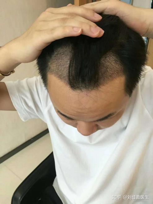 脱发掉发严重怎么办到医院都做什么检查 v2-4fee02a65ecda63c0230031a7bd42ff7_r.jpg