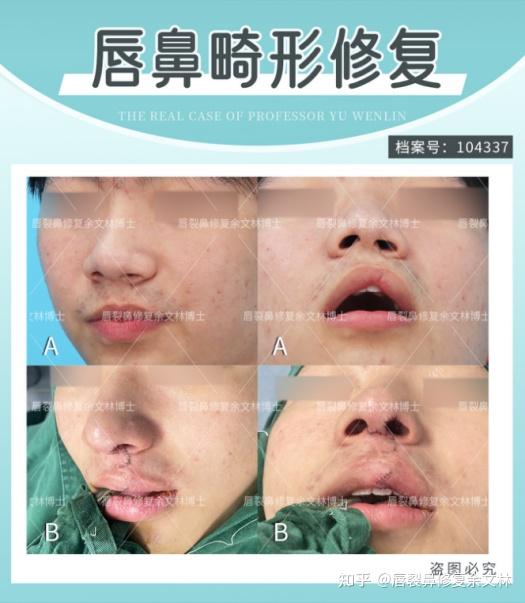 18岁成人礼:修复兔唇鼻畸形! - 知乎