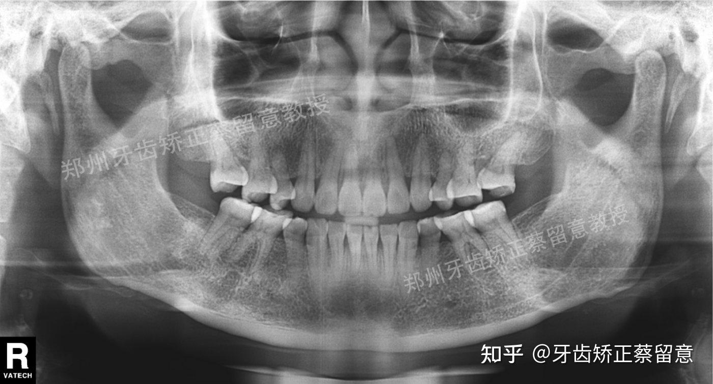 舌骨x线图片图片