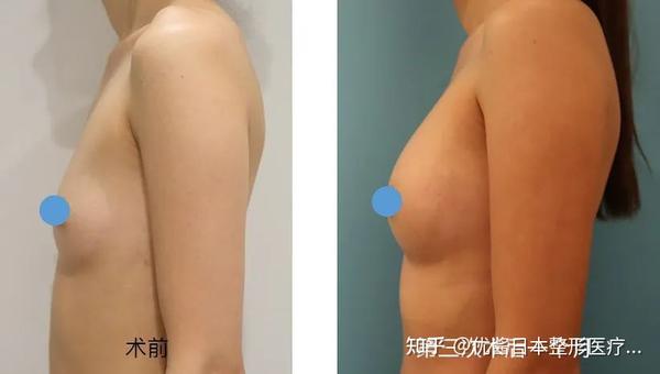 医生授权 优酱搬运 不会被别人发现 的神仙丰胸术 居然有这么多 坑 知乎