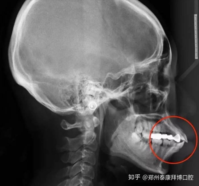 这张片子就是牙性骨性混合存在的,因为骨性程度严重,只能通过正畸 正