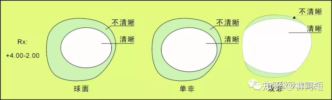 非球面鏡片對比普通外單非鏡片的優點:如圖四,雙非鏡片的第一面(外